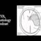 CVA Aetiology Podcast